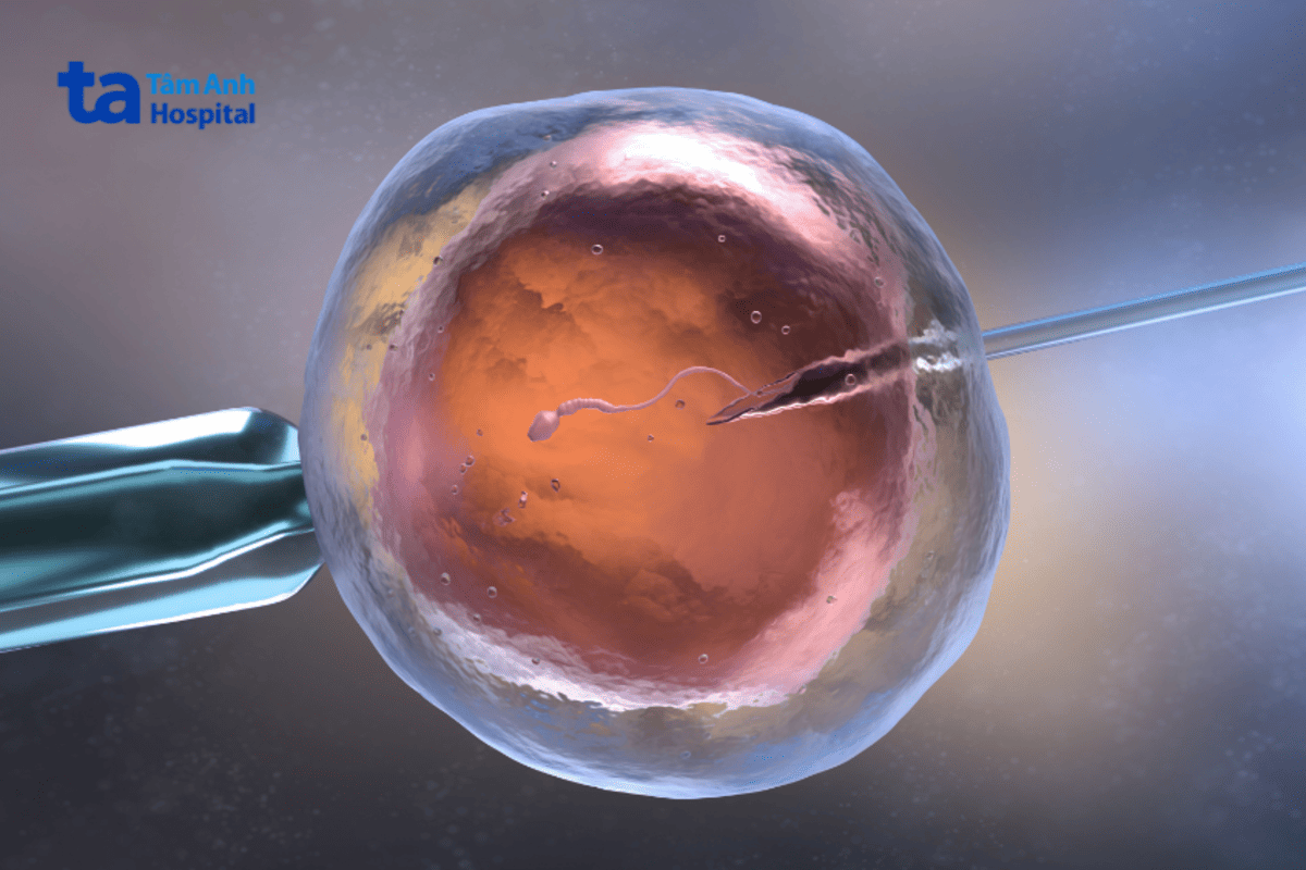 kỹ thuật ivf
