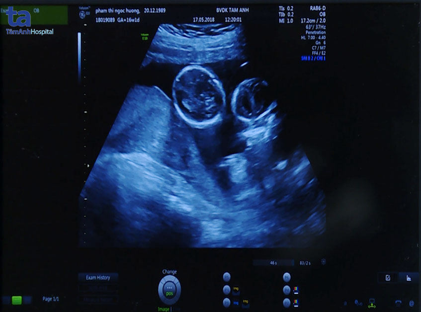 Hình tam thai siêu âm