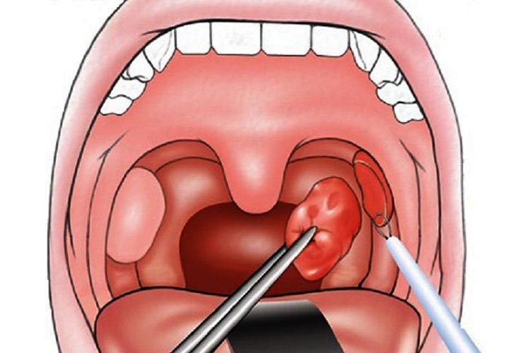 công nghệ cắt amidan bằng plasma