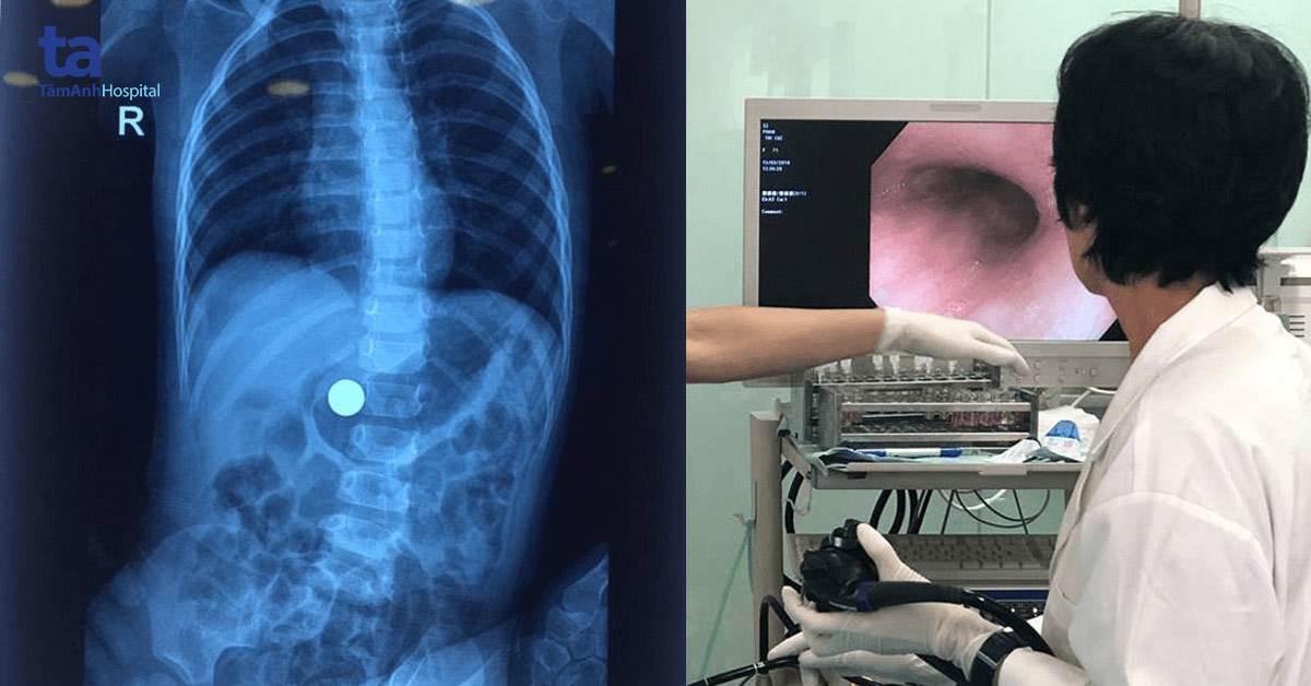 Bé 21 tháng Hà Nội khóc nấc quặn người, suýt chết vì bà khoắng tay vào miệng móc dị vật