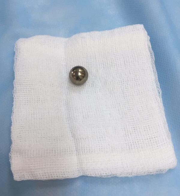 Viên bi sắt được gắp ra ngoài Viên bi sắt được gắp ra ngoài