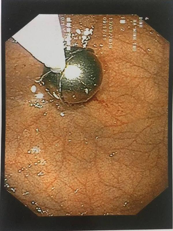 Bác sĩ đã phải dùng rọ gắp sỏi chuyên biệt và tập trung tinh thần cao độ để gắp viên bi sắt ra ngoài be-21-thang-ha-noi-khoc-nac-quan-nguoi-suyt-chet-vi-ba-khoang-tay-vao-mieng-moc-di-vat01