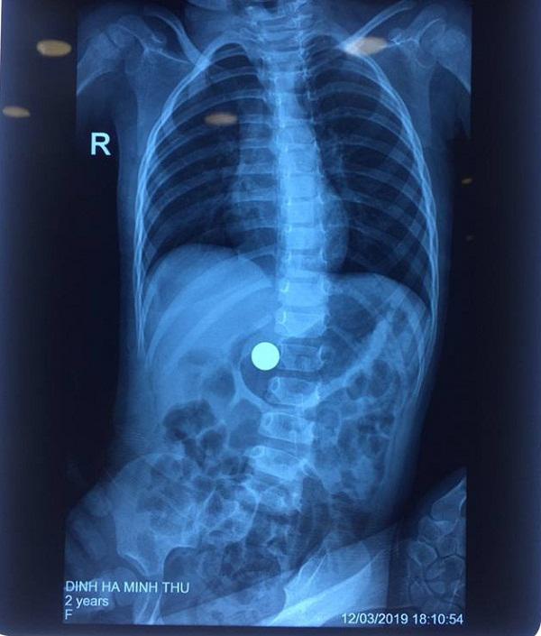 Vùng bụng của bệnh nhi có dị vật là viên bi sắt có kích thước lớn be-21-thang-ha-noi-khoc-nac-quan-nguoi-suyt-chet-vi-ba-khoang-tay-vao-mieng-moc-di-vat1