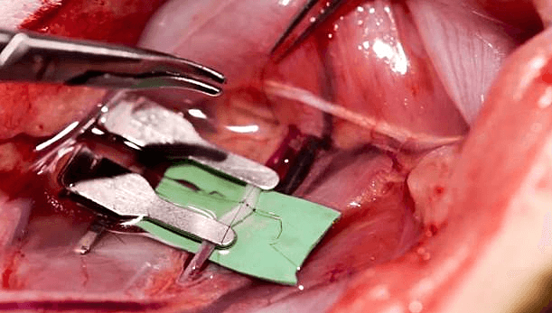 Vi phẫu thuật là kỹ thuật khó, chỉ có thể được thực hiện bởi những chuyên gia giỏi và thiết bị hiện đại. Vi phẫu thuật là kỹ thuật khó, chỉ có thể được thực hiện bởi những chuyên gia giỏi và thiết bị hiện đại.