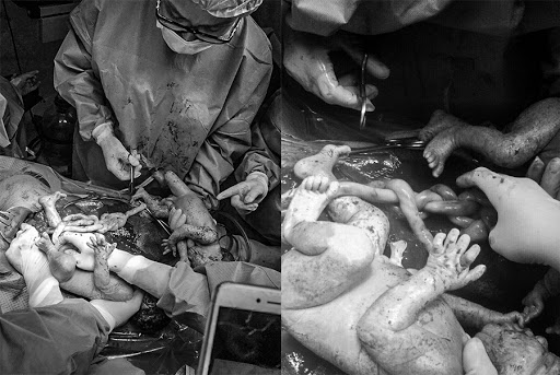 Ca “đại phẫu thuật” diễn ra trong sự căng thẳng và cẩn trọng đặc biệt của ekip bác sĩ BVĐK Tâm Anh, Hà Nội