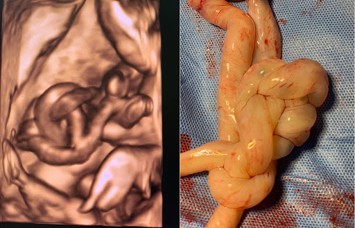 Hình ảnh siêu âm thai phát hiện tình trạng dây nhau xoắn thắt nút (trái) và dây nhau sau ca phẫu thuật (phải)/Ảnh: BVĐK Tâm Anh, Hà Nội