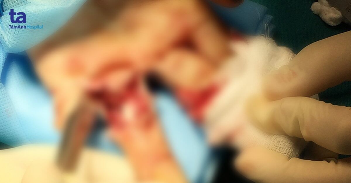 2 tiếng “cân não” cứu bàn tay bị dập nát vì tai nạn lao động