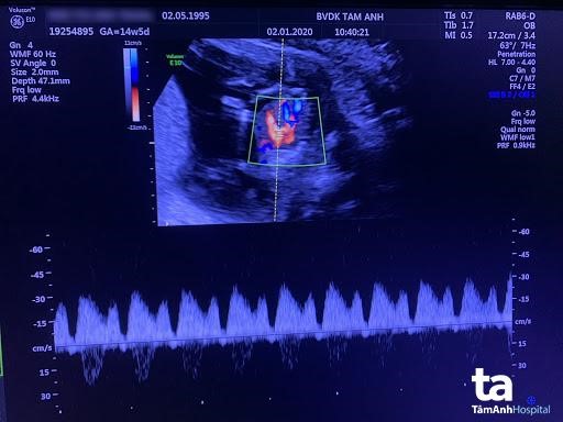Siêu âm thai nhi trước khi mổ