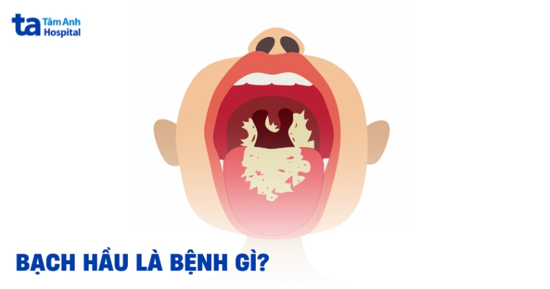 Bệnh bạch hầu là bệnh gì? Nguyên nhân và triệu chứng nhận biết