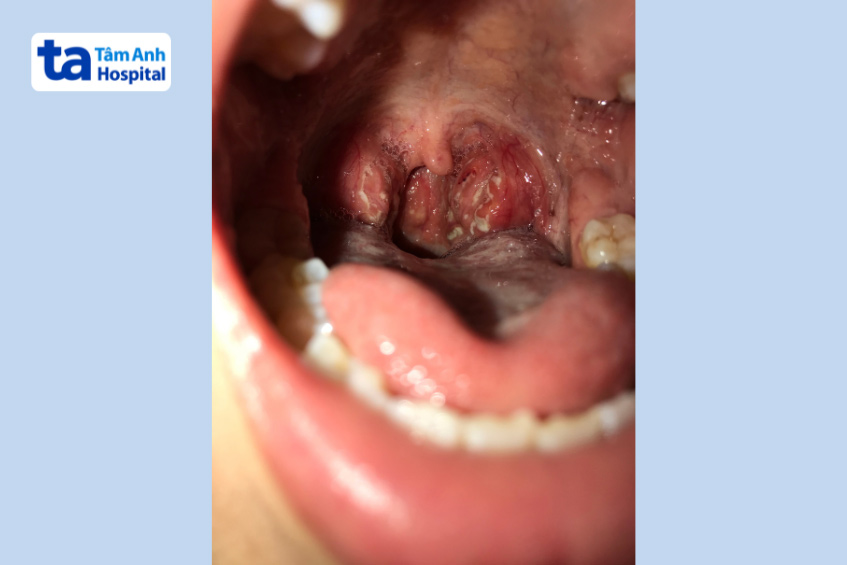 vi khuẩn gây tổn thương vùng hầu họng