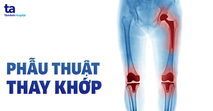 phẫu thuật thay khớp