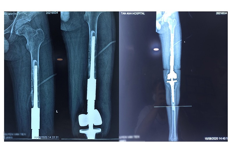 Phin chụp chân bệnh nhân sau phẫu thuật