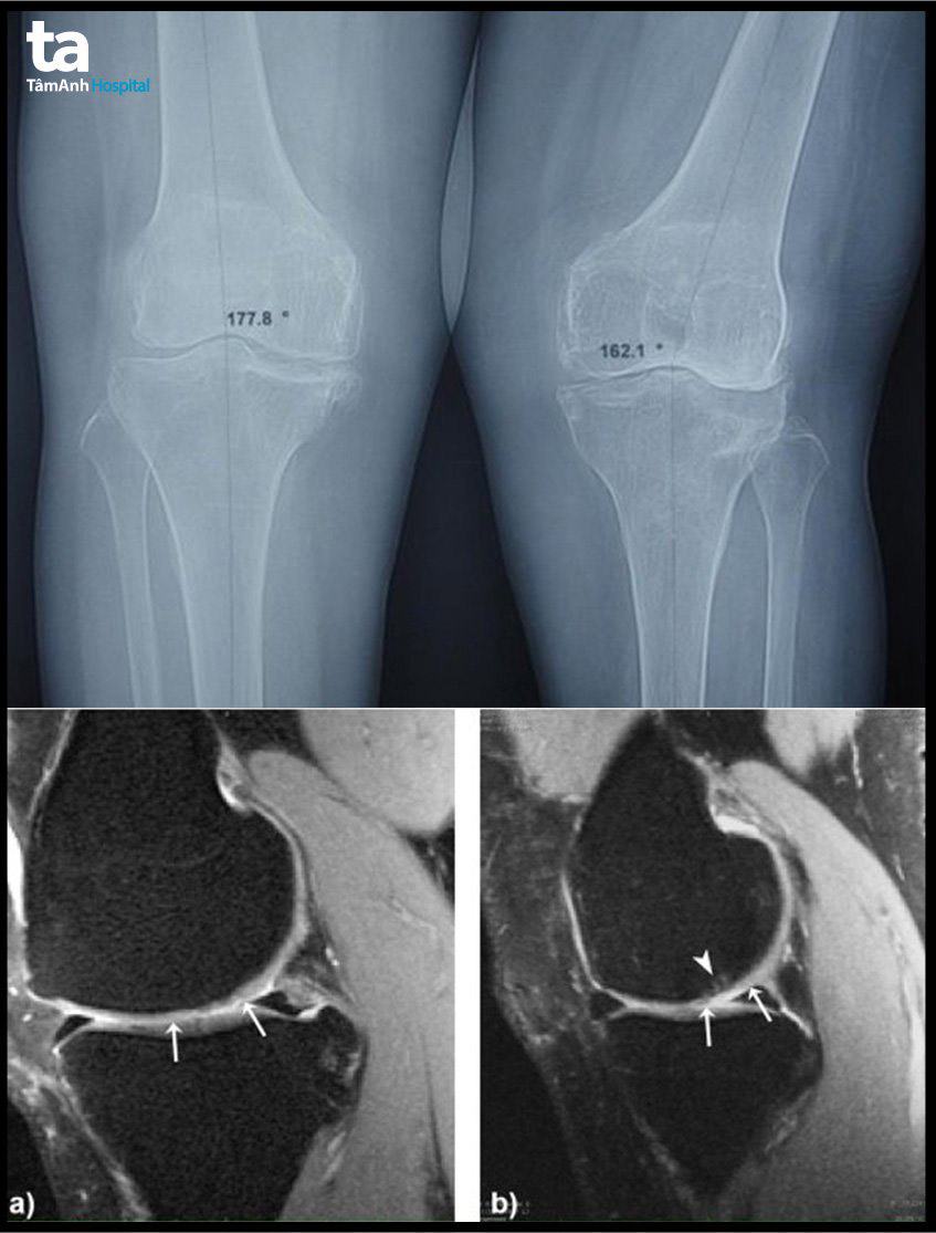 hình ảnh học thoái hóa khớp gối
