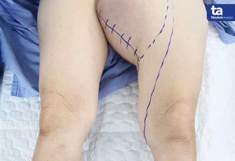 khoi u o dui cua benh nha