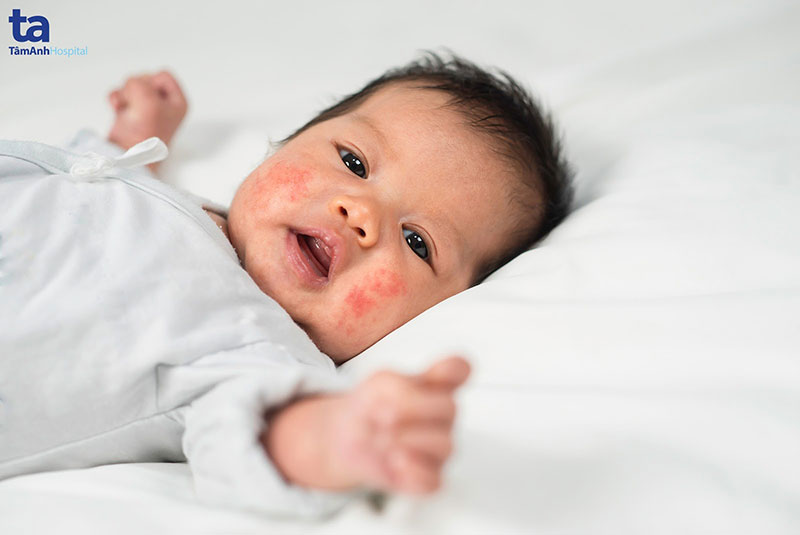 Viêm da dị ứng là bệnh giao mùa thu đông thường gặp ở trẻ sơ sinh và trẻ nhỏ