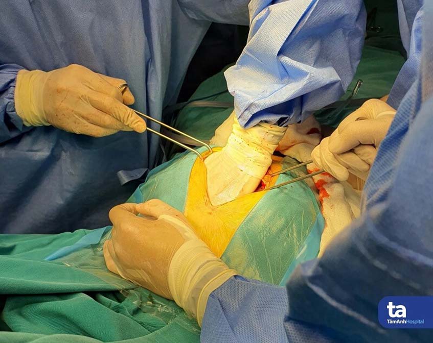 bóc khối u khổng lồ cho bệnh nhân