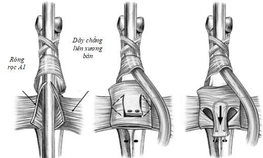 làm ngắn bao khớp