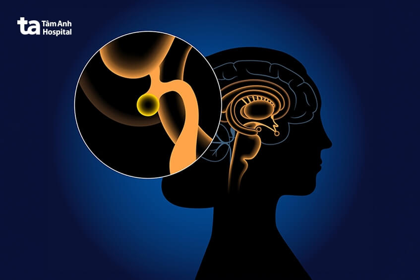 u tuyến tùng cần phẫu thuật