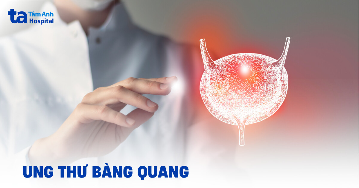 Ung thư bàng quang: Nguyên nhân, dấu hiệu, chẩn đoán và điều trị