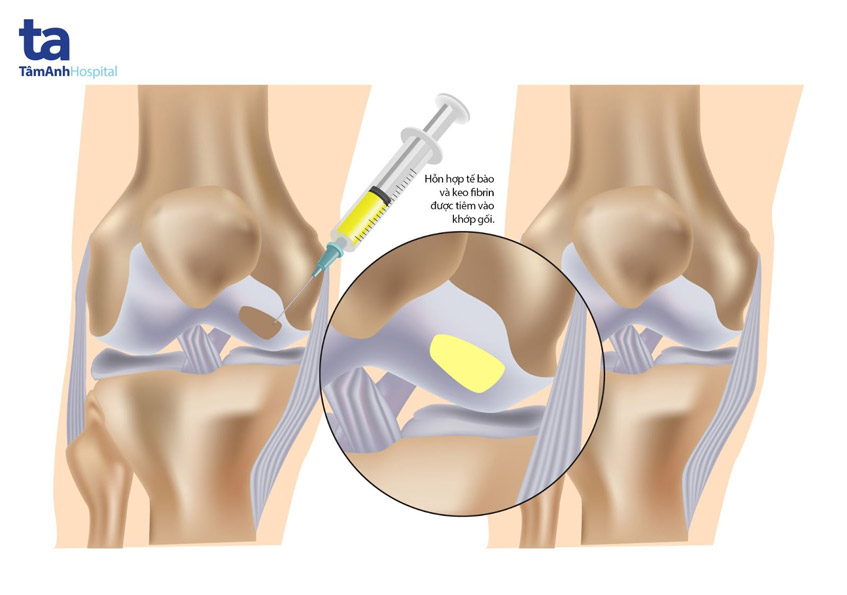 dieu tri ton thuong co