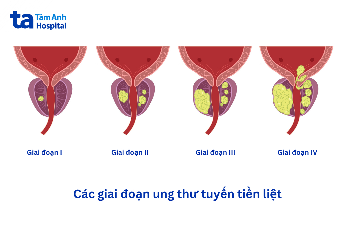 giai đoạn ung thư tiền liệt tuyến