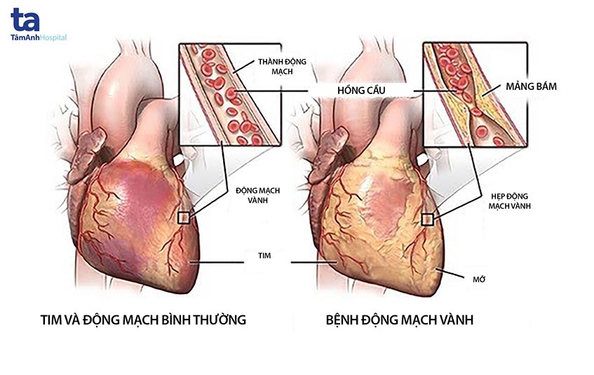 Can thiệp động mạch vành qua da (PCI) trong Tim mạch