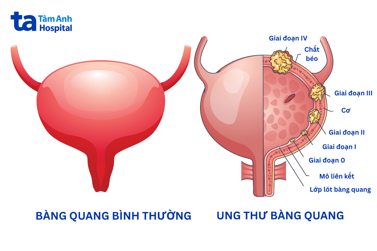 nhận biết giai đoạn ung thư bàng quang