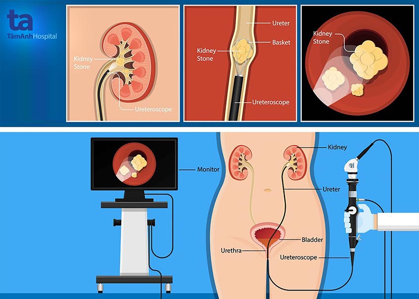 tan soi nguoc dong bang ong mem
