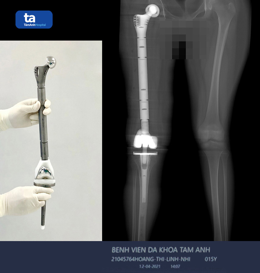 thay xuong titan
