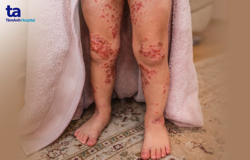 Trẻ bị bội nhiễm tại các vết loét của bệnh tay chân miệng