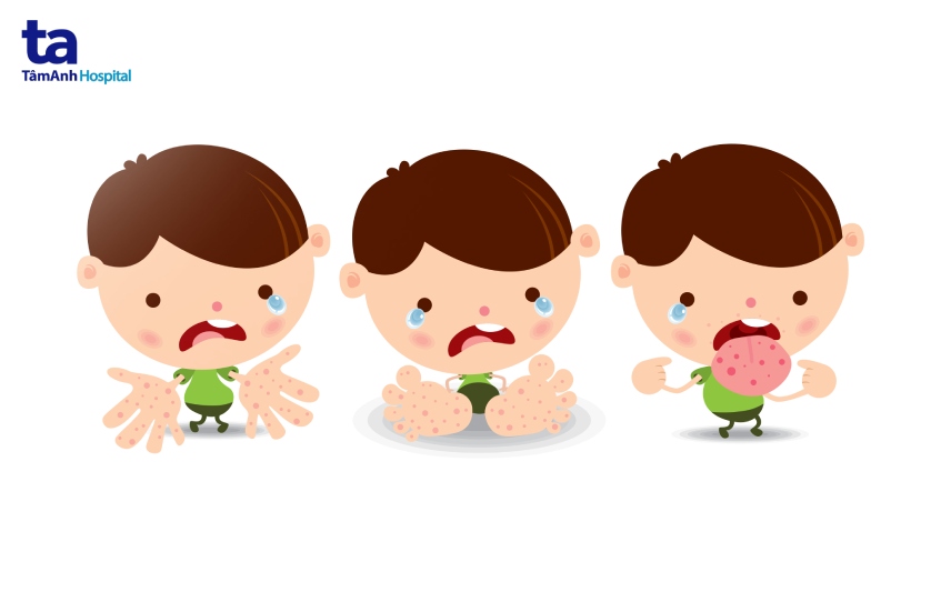 Trẻ phát ban ở tay, chân, miệng khi mắc bệnh