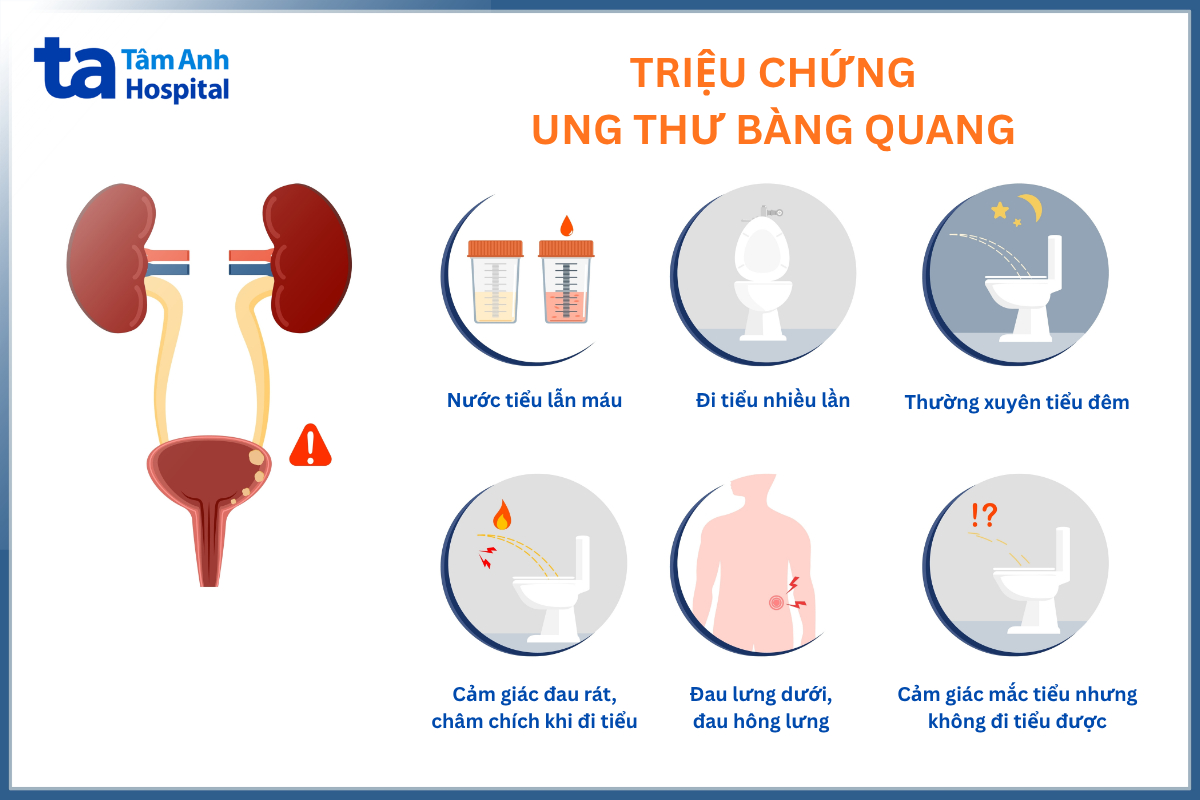 triệu chứng ung thư bàng quang dễ nhầm lẫn