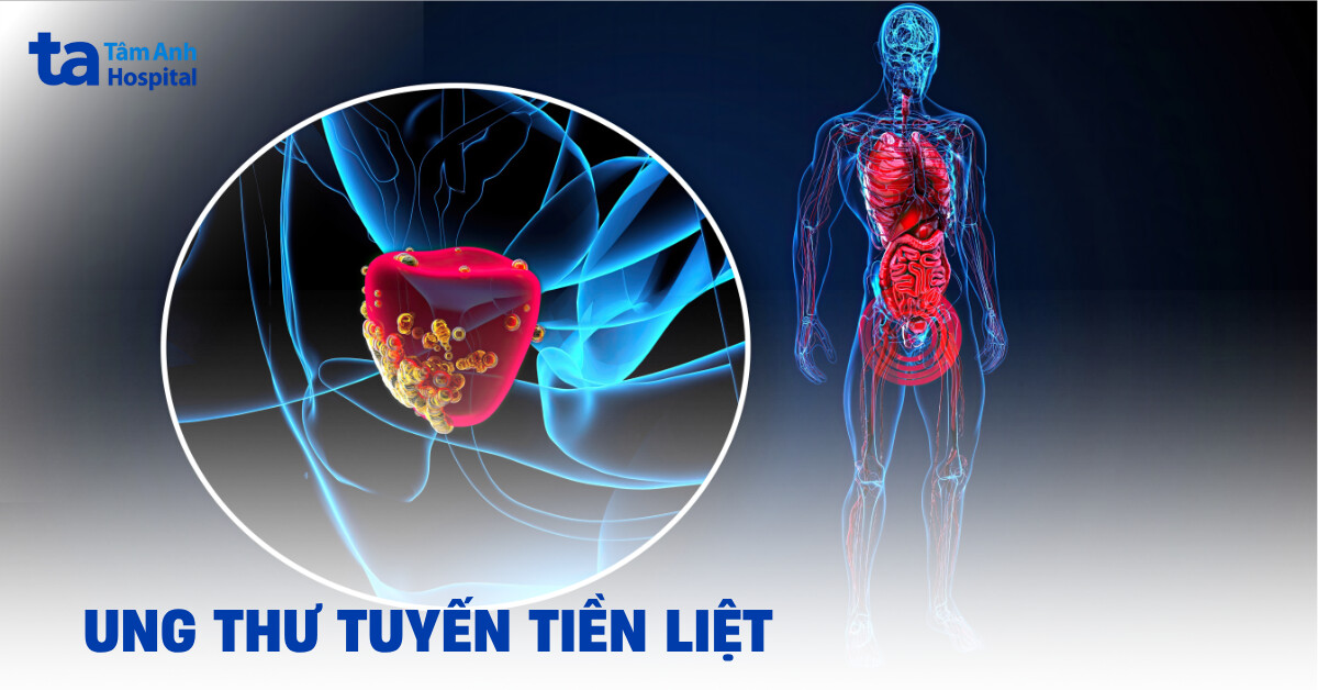 ung thư tuyến tiền liệt