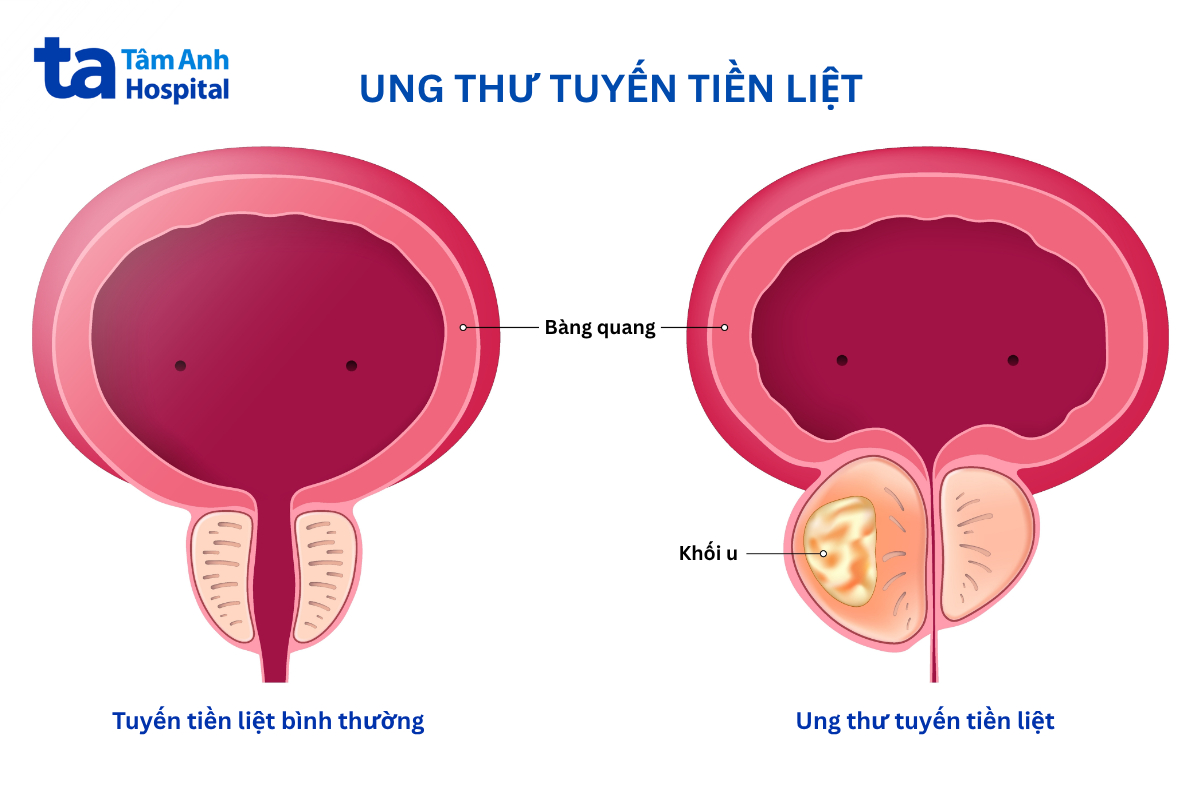 ung thư tuyến tiền liệt xảy ra do sự phát triển bất thường