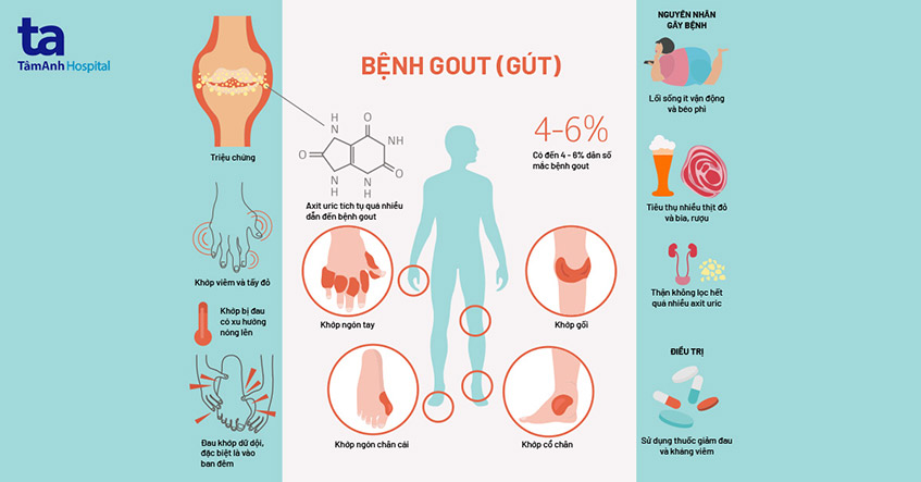Bệnh Gout (Gút): Nguyên nhân, triệu chứng, chẩn đoán, phòng ngừa