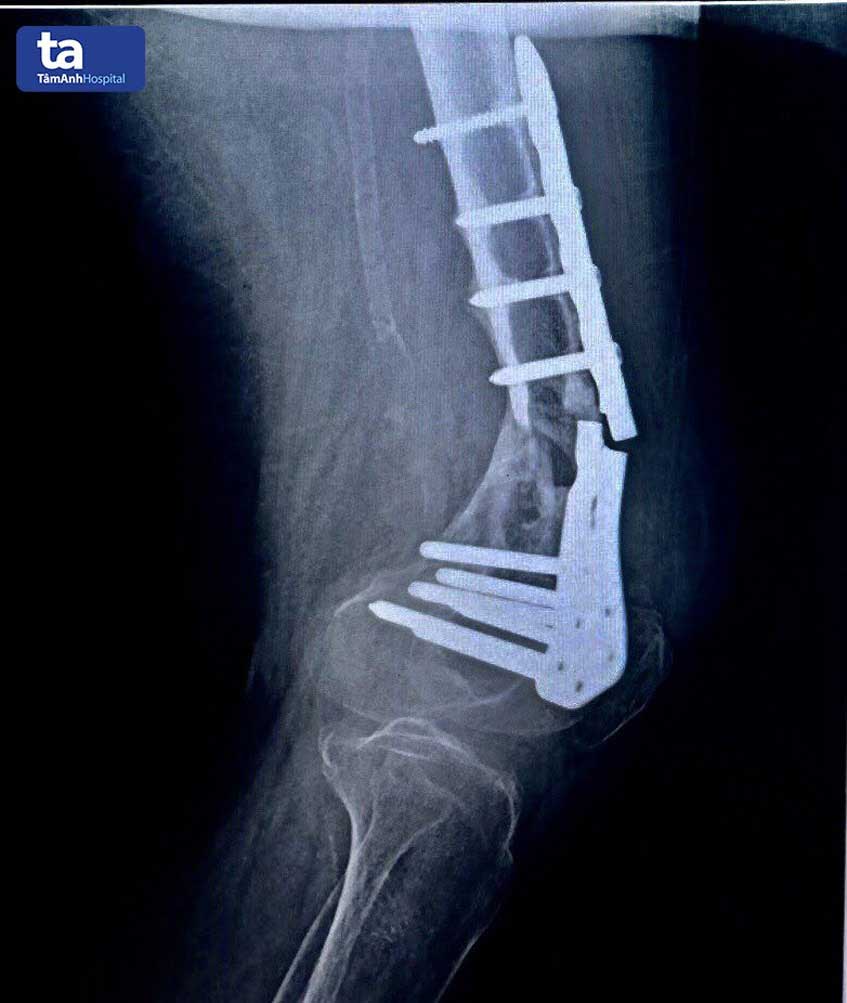 bệnh nhân 70 tuổi gãy nẹp xương đùi