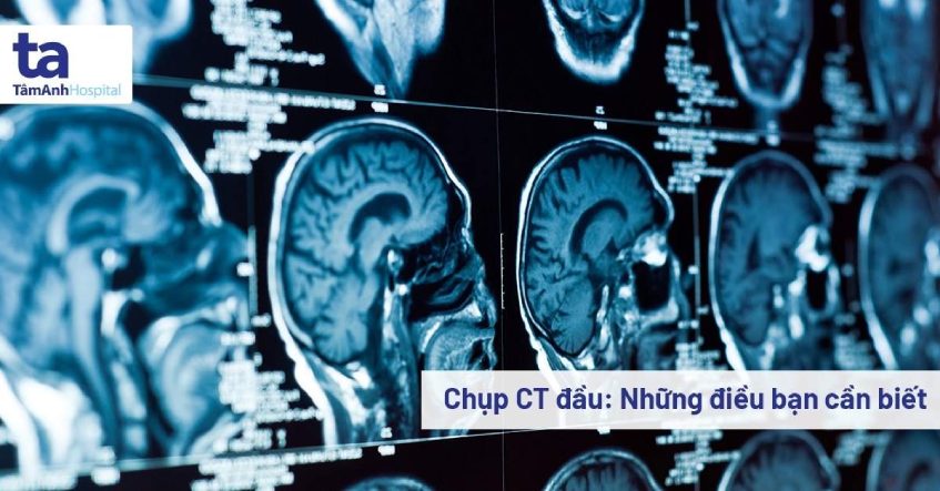 chụp ct đầu