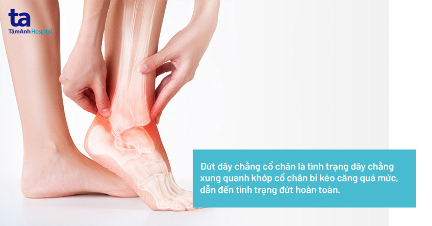 Đứt dây chằng cổ chân: Nguyên nhân, dấu hiệu, chẩn đoán và điều trị