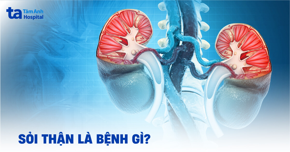 sỏi thận là bệnh gì