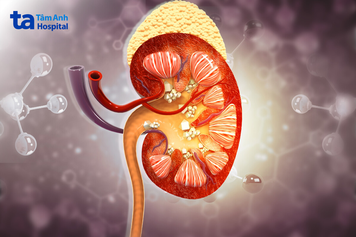 sỏi tiết niệu là như thế nào