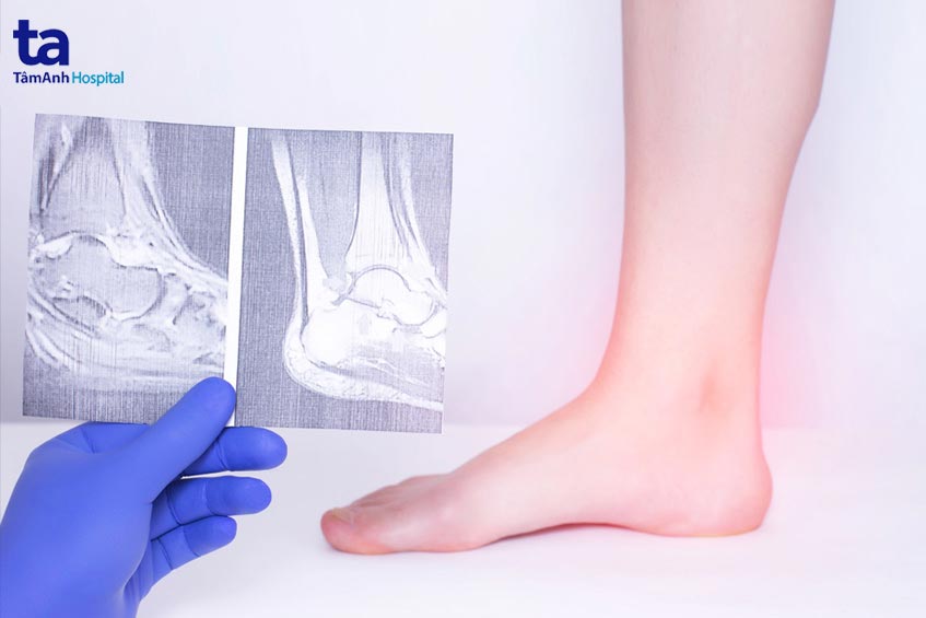 hinh anh xquang cua viem khop vo khuan