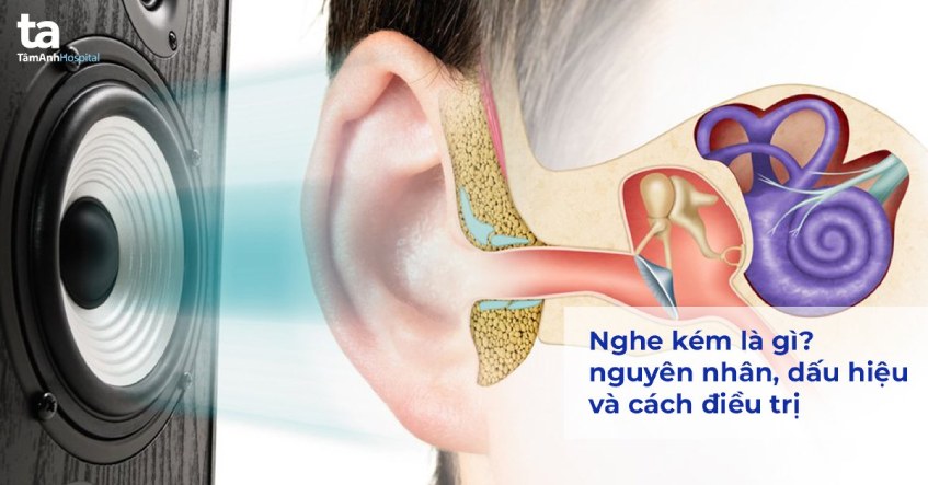 Nghe kém là gì? nguyên nhân, triệu chứng và phòng ngừa
