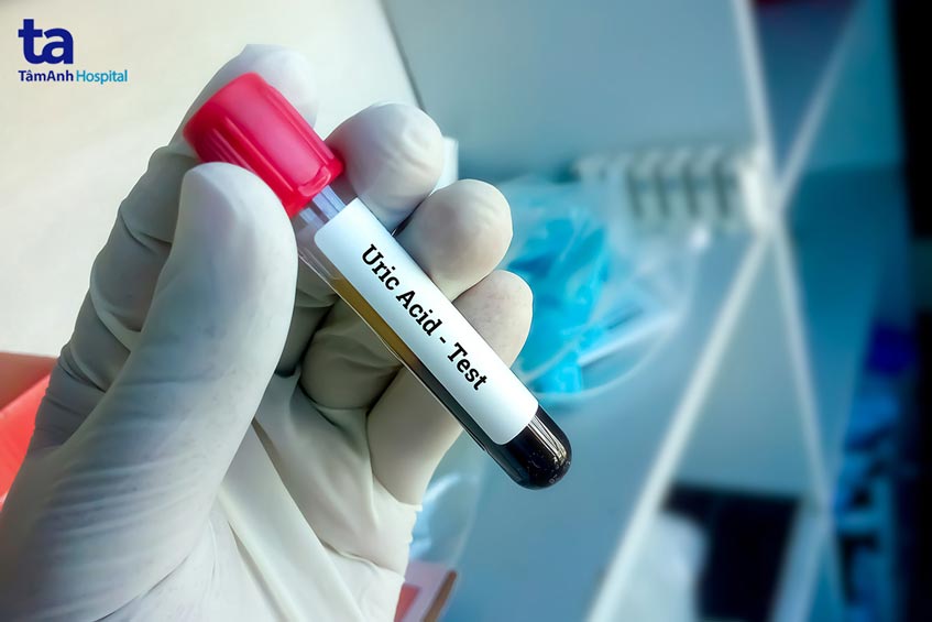 benh gout co yeu to di truyen khong