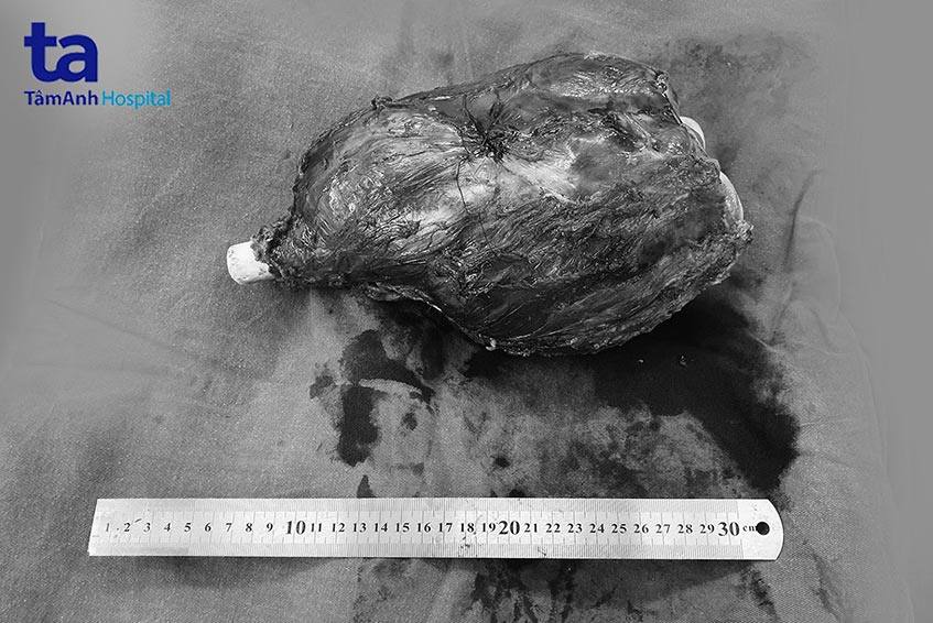 khối u khổng lồ