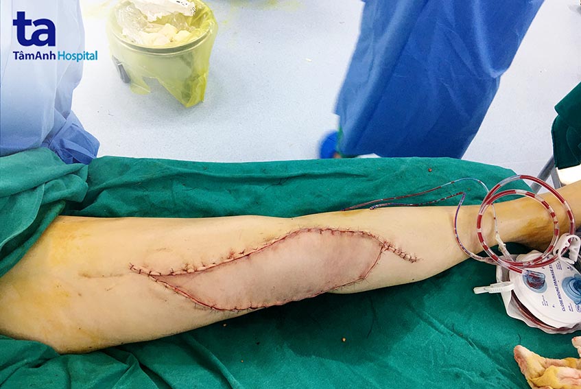Hình ảnh chân sau khi phẫu thuật