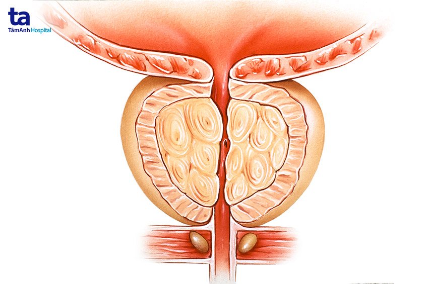 sơ đồ minh họa tuyến tiền liệt