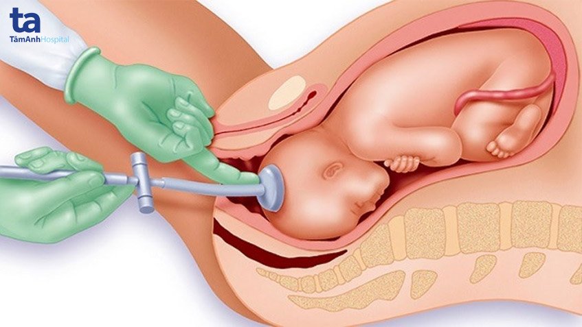 Phương pháp Ventouse