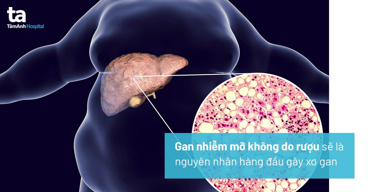10 Câu hỏi thường gặp về bệnh gan nhiễm mỡ không do rượu
