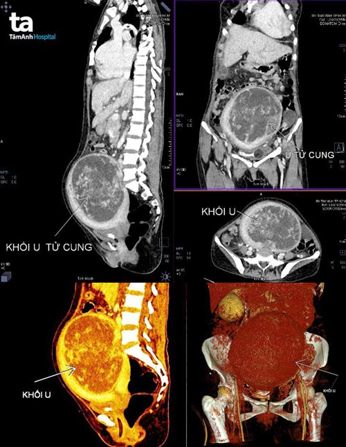 hình ảnh ct scan bụng của chị tuyền