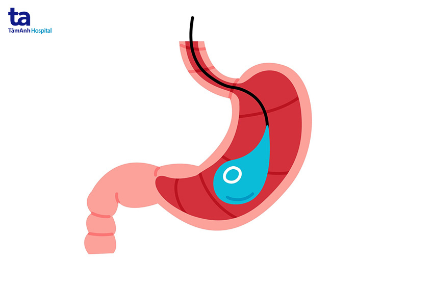 dat-bong-phau-thuat-giam-can